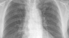 Was there tuberculosis 500,000 years ago?